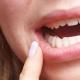 Wie genießen Sie Stomatitis in Ihrem Mund?